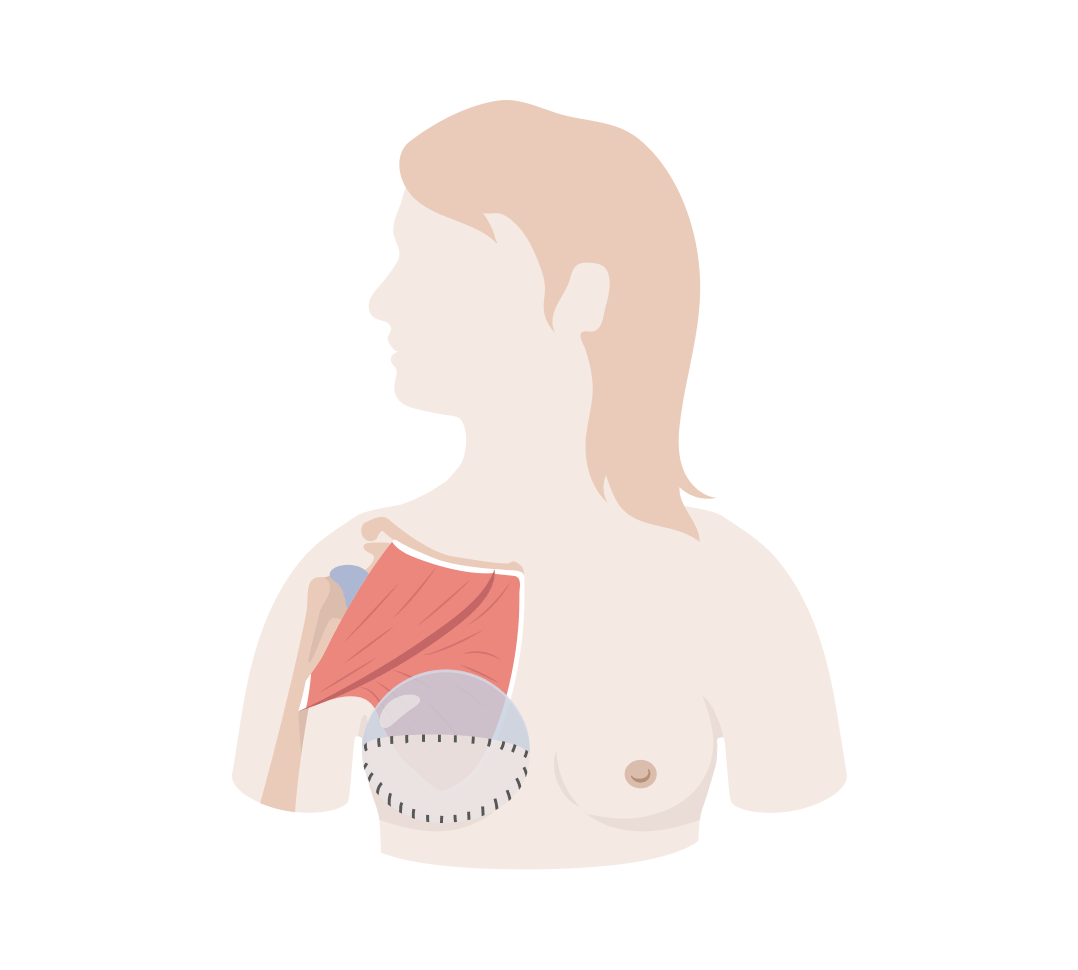 Breast Reconstruction Protocol